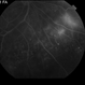 Proliferative Diabetic Retinopathy with Vitreous Hemorrhage - FA late Proliferative Diabetic Retinopathy with Vitreous Hemorrhage - FA late
