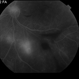Proliferative Diabetic Retinopathy with Vitreous Hemorrhage - FA Proliferative Diabetic Retinopathy with Vitreous Hemorrhage - FA