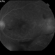 Proliferative Diabetic Retinopathy with Vitreous Hemorrhage - FA Proliferative Diabetic Retinopathy with Vitreous Hemorrhage - FA
