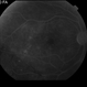 Proliferative Diabetic Retinopathy with Vitreous Hemorrhage - FA late Proliferative Diabetic Retinopathy with Vitreous Hemorrhage - FA late