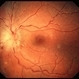 Toxoplasma Neuroretinitis (Jensen`s Disease) Toxoplasma Neuroretinitis (Jensen`s Disease)