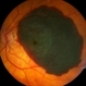 Subfoveal Subretinal Hemorrhage Subfoveal Subretinal Hemorrhage