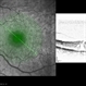 Stage 2 Macular Holes Pre-JETREA Wright OCT Stage 2 Macular Holes Pre-JETREA Wright OCT