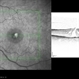 Stage 2 Macular Hole Pre JETREA Stage 2 Macular Hole Pre JETREA