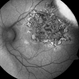 Serpiginous like Choroiditis Serpiginous like Choroiditis