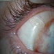 Scleral Buckle Suture 1