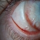 Scleral Buckle Suture