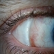 Scleral Buckle Suture