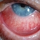 Scleritis