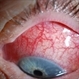 Scleritis