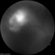 Sclerochoroidal Calcification AF Sclerochoroidal Calcification AF