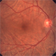 Bilateral Idiopathic Choroidal Folds Bilateral Idiopathic Choroidal Folds