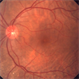 Bilateral idiopathic choroidal folds Bilateral idiopathic choroidal folds