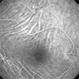 Idiopathic Choroidal Folds - Fluorescein Angiogram Idiopathic Choroidal Folds - Fluorescein Angiogram
