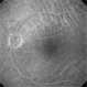Choroidal Folds - Fluorescein Angiogram Choroidal Folds - Fluorescein Angiogram