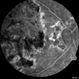Serpiginous Choroiditis Serpiginous Choroiditis
