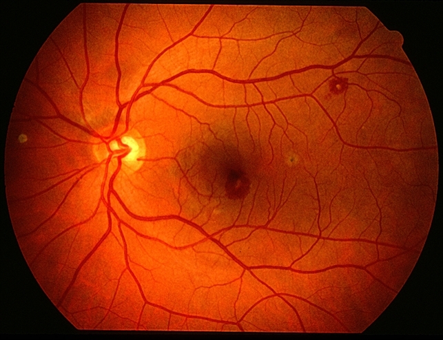 Roth Spot Retina Image Bank