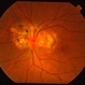 Serpiginous Choroiditis Serpiginous Choroiditis