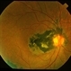 Serpiginous Choroiditis Serpiginous Choroiditis