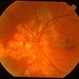 Serpiginous Choroiditis Serpiginous Choroiditis
