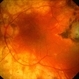 Serpiginous Choroiditis Serpiginous Choroiditis