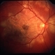 Serpiginous Choroiditis Serpiginous Choroiditis
