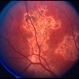 Serpiginous Choroiditis Serpiginous Choroiditis