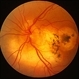 Serpiginous Choroiditis Serpiginous Choroiditis