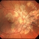 Serpiginous Choroiditis Serpiginous Choroiditis