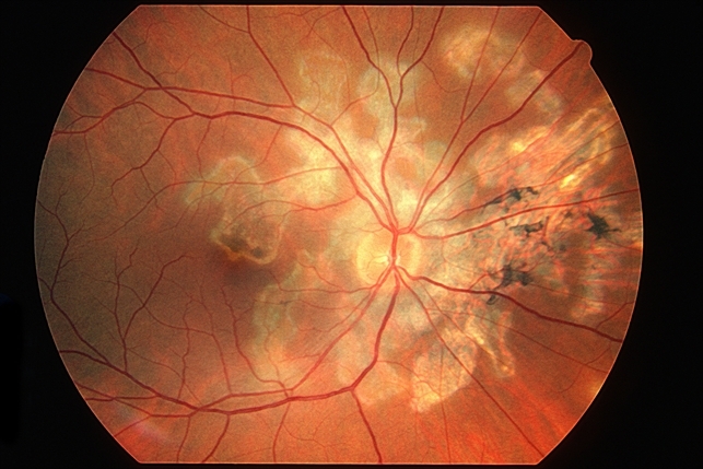 serpiginous choroiditis retina image bank american sign