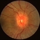 Sarcoidosis Sarcoidosis