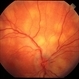 Sarcoidosis Choroiditis Sarcoidosis Choroiditis