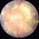 Bilateral  Optic Nerve Involvement in Sarcoidosis Bilateral  Optic Nerve Involvement in Sarcoidosis