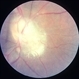 Bilateral  Optic Nerve Involvement in Sarcoidosis Bilateral  Optic Nerve Involvement in Sarcoidosis