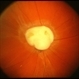 Toxocara Granuloma Toxocara Granuloma