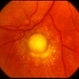 Toxocara Granuloma Toxocara Granuloma