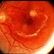 Toxocara Granuloma Toxocara Granuloma