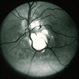 Toxocara Granuloma Toxocara Granuloma