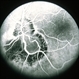 Toxocara Granuloma Toxocara Granuloma