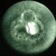 Toxocara Granuloma Toxocara Granuloma