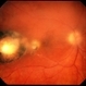 Toxoplasma Retinochoroiditis Toxoplasma Retinochoroiditis