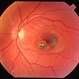 Secondary Choroidal Neovascularization Due to Toxoplasmosis Secondary Choroidal Neovascularization Due to Toxoplasmosis