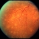 Tuberculosis Panuveitis Tuberculosis Panuveitis
