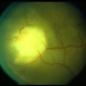 Tuberculosis Granuloma of the Choroid Tuberculosis Granuloma of the Choroid