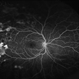 Sickle Cell Retinopathy
