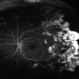 Sickle Cell Retinopathy Sickle Cell Retinopathy