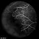 Sickle Cell Retinopathy Sickle Cell Retinopathy