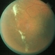Proliferative Sickle Retinopathy Stage 3 Proliferative Sickle Retinopathy Stage 3