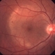 Acute Syphilitic Posterior Placoid Chorioretinitis Acute Syphilitic Posterior Placoid Chorioretinitis