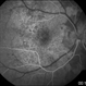 Acute Syphilitic Posterior Placoid Chorioretinitis Acute Syphilitic Posterior Placoid Chorioretinitis